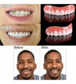 ⁦طقم أسنان علوي Perfect Smile قابل للإزالة – ابتسامة فورية بشكل طبيعي⁩ - الصورة ⁦2⁩
